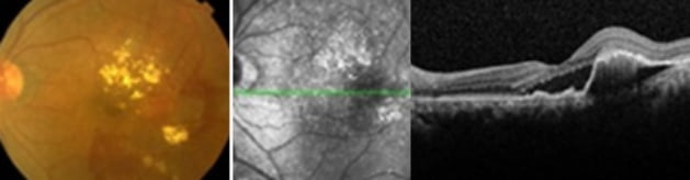 건성 황반변성 이미지